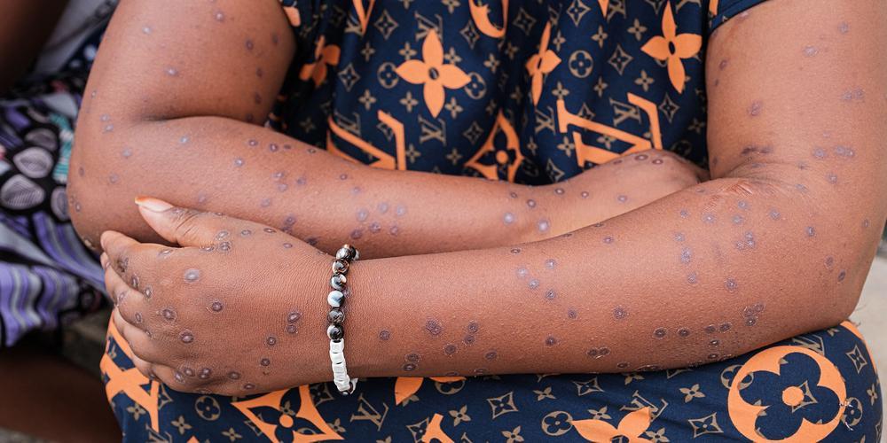 Un cas de Mpox détecté au Sénégal, Dakar prend des mesures pour lutter contre la maladie